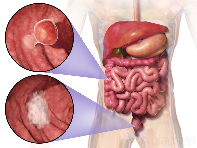 cancer caused due to nuclear radiation leakage